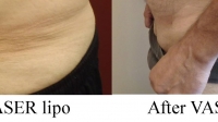 pt 44: Side view of Before and After of VASER by Dr. David, of fat just above a man's pubic area.This is a common complaint of both men and women.