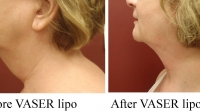 pt 46:VASER of woman's neck by Dr. David