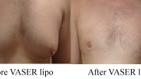 pt 47: VASER of gynecomastia by Dr. David