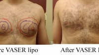 Pt 5: VASER of male chest by Dr. David
