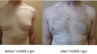 pt 50: VASER of gynecomastia by Dr. David