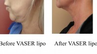 pt-500: VASER Lipo of neck fat by Dr. David