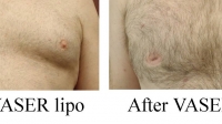 pt 51: VASER of male chest by Dr. David