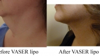 pt 52: Neck VASER by Dr. David