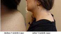 pt 53: VASER by Dr. David of excess fat deposit on upper back of woman