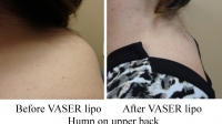 pt 54: VASER of abnormal "hump" of fat deposit on patient's upper back