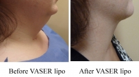 pt 55: VASER of woman's neck by Dr. David