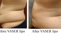 pt 56: VASER of a woman's large protruding abdomen with an overhanging "panniculus". Notice the skin tightening of the VASER in a woman who came in, thinking she needed a "tummy tuck"