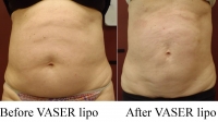 pt 59: VASER of abdomen