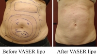 pt 60: VASER of abdomen