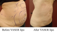 pt 61: VASER of abdomen