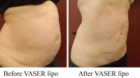 pt 63: VASER of woman's abdomen