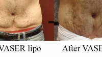 pt 64: CORRECTIVE VASER LIPO on a man with severe scarring from previous lipo performed elsewhere.Dr.David used the VASER to liquify the scar tissue, remove the tissue, and smooth him out.