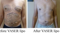 pt 69: VASER of male chest and abdomen by Dr. David