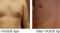 pt 7: VASER by Dr. David of gynecomastia in a teenager