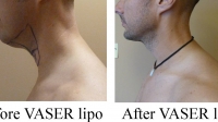 pt 70: VASER of male neck by Dr. David