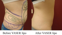 pt 75: VASER by Dr.. David of woman's flanks and abdomen (side view)