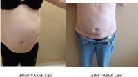 pt 76: VASER of large abdomen by Dr. David.Notice VASER's skin tightening ability, even in the face of a large amount of fat removal.