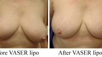 pt 77: VASER minimally invasive breast reduction in a woman with uneven breasts-- by Dr. David