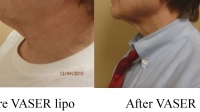 pt 78: VASER of neck by Dr. David