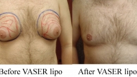 pt 79 VASER of male chest by Dr. David