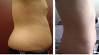 pt 8: VASER of abdomen and love handles in a young man (by Dr. David)