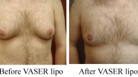 pt 80: VASER of male chest byVASER of male chest by Dr. David