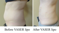 pt 81: VASER of abdomen by Dr. David