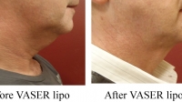 pt 84: VASER of male neck by Dr. David
