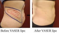 pt 85: VASER by Dr.. David of woman's flanks and abdomen (side view)