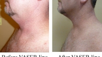 pt 88: VASER of male neck by Dr. David