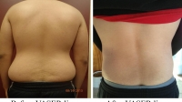 pt 9: VASER of male back and love handles by Dr. David