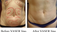 pt 94: VASER of woman's abdomen by Dr. David