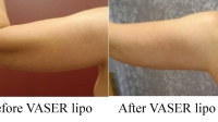 pt 95: VASER of woman's arms by Dr. David. Preliminary result