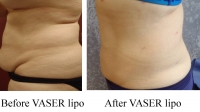 pt 96 :VASER of a woman's large protruding abdomen with and overhanging "panniculus". Notice the skin tightening of the VASER in a woman who came in, thinking she needed a "tummy tuck"