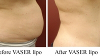 pt 98: VASER of woman's abdomen by Dr. David