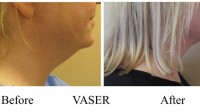 pt192: VASER of a woman's neck by Dr. David. Side view